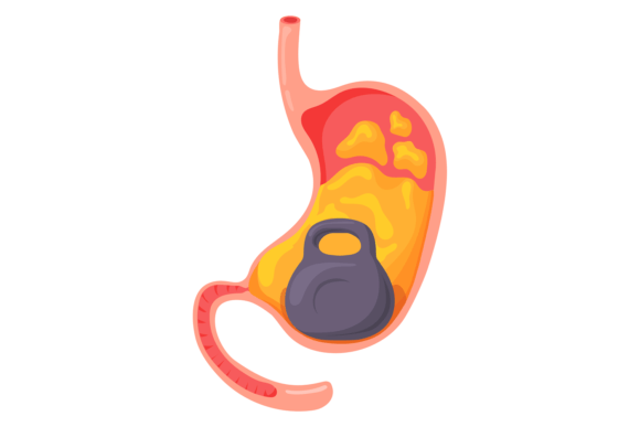Heavy Stomach Syndrome. Cartoon Medical Graphics